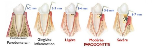 La parodontie médicale ou parodontologie médicale